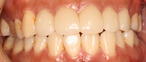 田村3　装着　正面